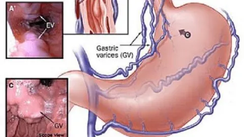Octreotide Và Cuộc Đua 72 Giờ Cứu Bệnh Nhân Xuất Huyết Do Vỡ Giãn Tĩnh Mạch Thực Quản